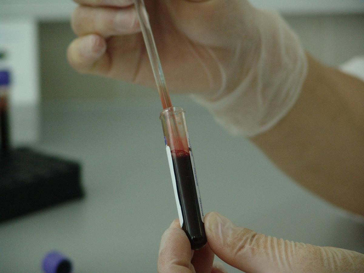 A clinical laboratory test result paper showing blood glucose and HbA1c values
